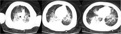 Case report: Microcirculatory leukocytes in a pediatric patient with severe SARS-CoV-2 pneumonia. Findings of leukocytes trafficking beyond the lungs